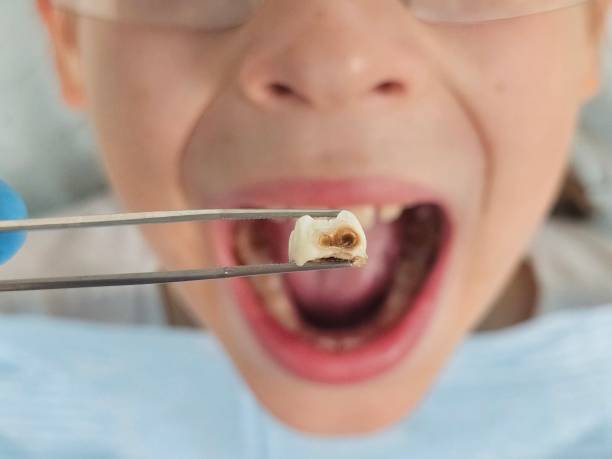 Best Broken or Chipped Tooth Repair in Sumas, WA